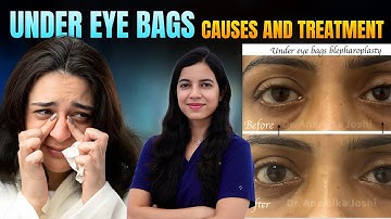 Under eye bags/ puffy eyes/ causes and treatment - explained by eye plastic surgeon Dr Anamika joshi