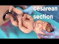 A cesarean section  known as a csection   is a surgery to deliver a baby via the abdomen