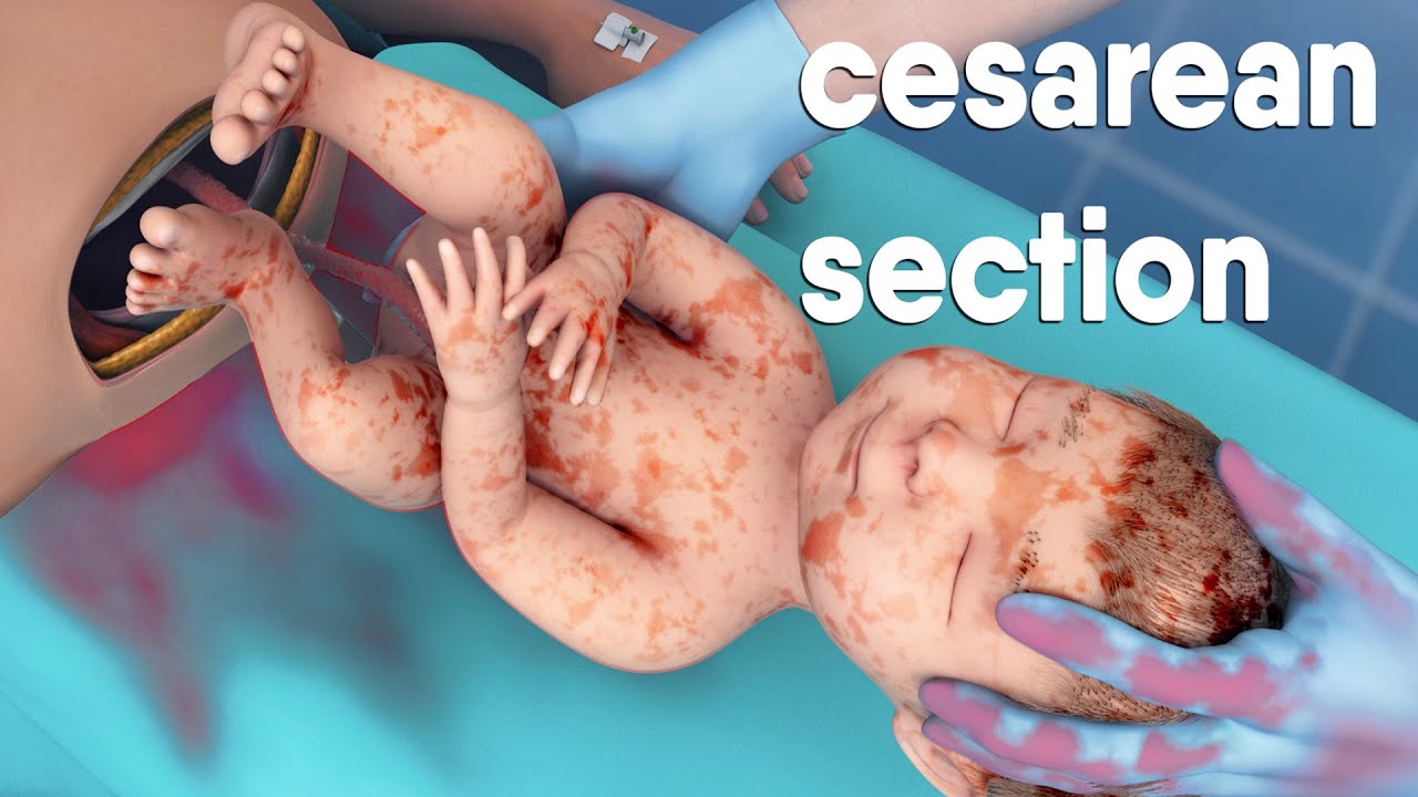 A cesarean section, known as a C-section