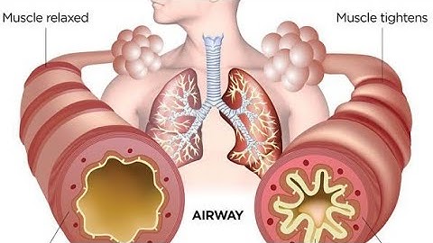 Bronchitis animation video.