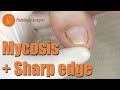 Mycosis + Sharp edge [Podología Integral] Integral Podology