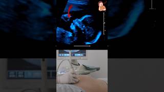 baby girl Yawning : Ultrasound Case shorts