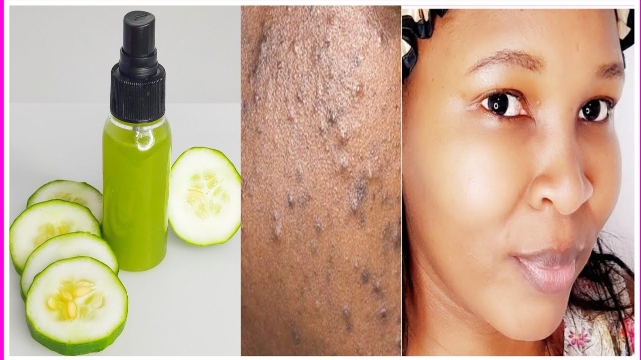 cucumber toner for acne