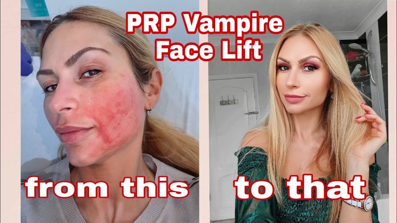 Vampire Facelift? I tried Microneedling with PRP! YouTube