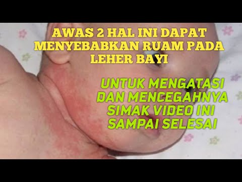 Video: 3 Cara Merawat Ruam Leher untuk Bayi Anda