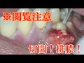 歯茎から多量の膿