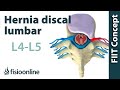 Hernia discal lumbar entre la L4 y L5 o cuarta y quinta vértebras lumbares