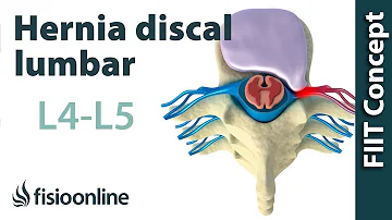 ¿A qué nervios afecta la L4 L5?