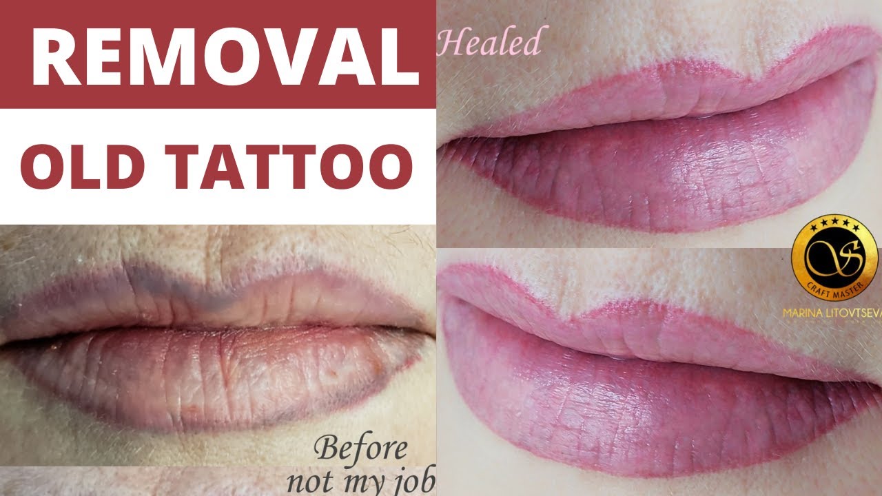 PMU Lip color correction. Laser lip tattoo removal Shorts YouTube