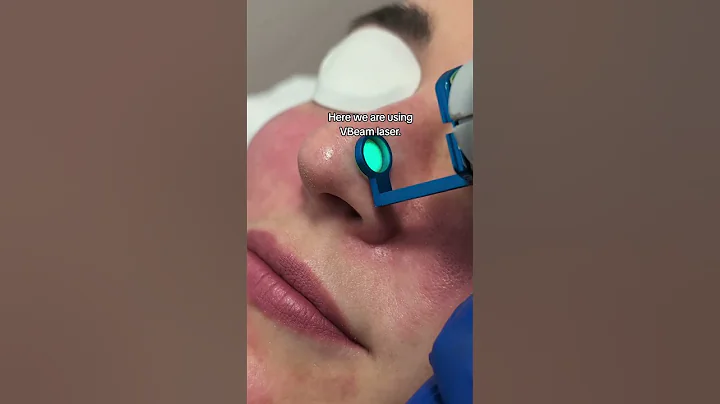 #vbeam Laser targets blood vessels to help achieve a smoother, more even complexion.#vbeamlaser
