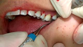 Gracey Instrumentation During Periodontal Therapy