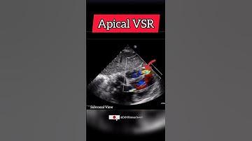 Post MI apical Ventricular Septal Rupture (VSR) on Echocardiography #cardiology #heart