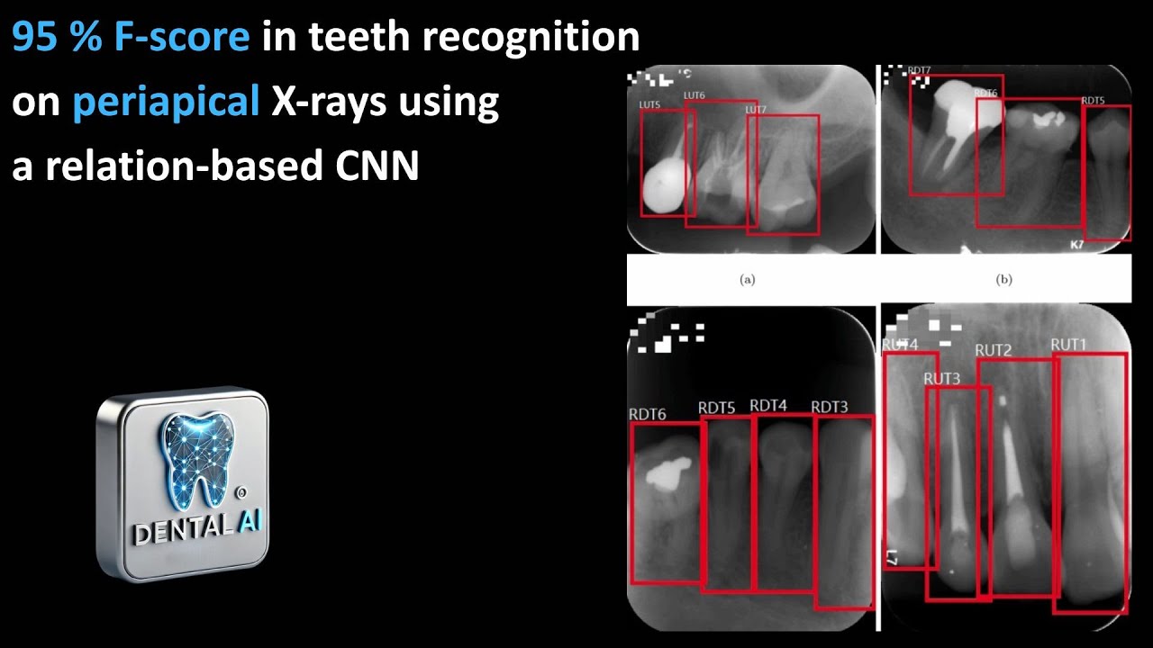 95% F Score in teeth recognition on periapical X rays using Faster R CNN