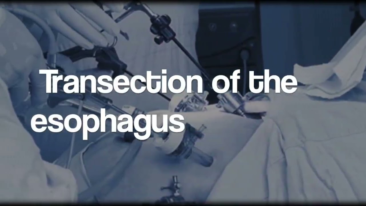 LAPAROSCOPIC PROXIMAL GASTRECTOMY AND ESOPHAGOJEJUNOSTOMY FOR GASTROESOPHAGEAL GIST