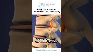 Details Lumbar Decompression Explained: Laminectomy vs Foraminotomy - Dr. Michael Kaiser Guide