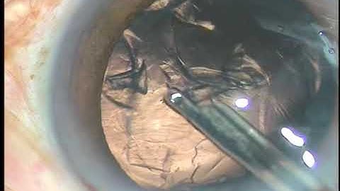 Lens Tilt Technique (LTT) for Soft cataracts.