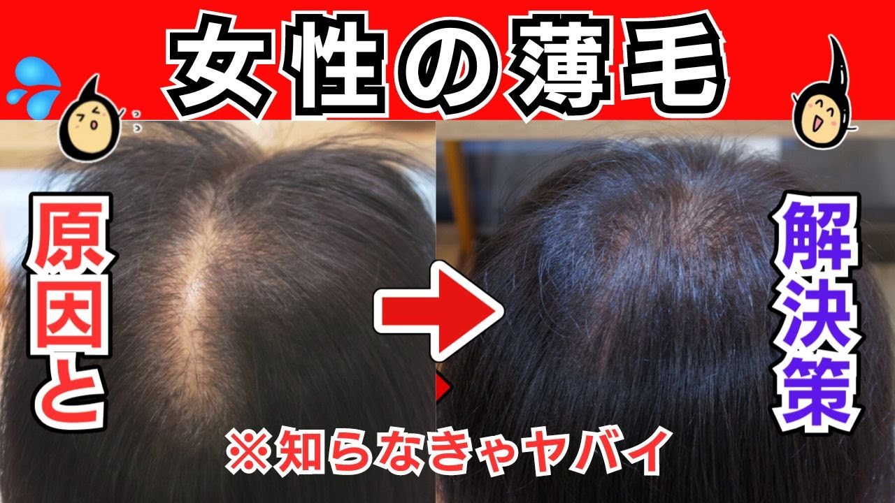 【抜け毛】女性の薄毛の原因と解決策 - YouTube