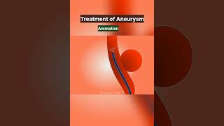 Aneurysm Treatment Procedure