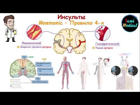 Диагностика инсультов в зависимости от локализации поражения в мозге| Правило 4-ёх| Легко и просто|