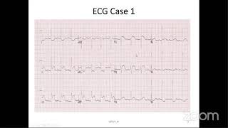 Gpep Uk 1St Ecg Workshop - 2Nd Session Part 2