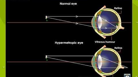 Hypermetropia or Hyperopia