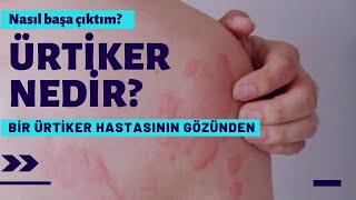 Ürtiker Nedir? Bir Ürtiker Hastası Olarak Ürtiker Sürecim Nasıl? | Sağlıklı Bilgiler