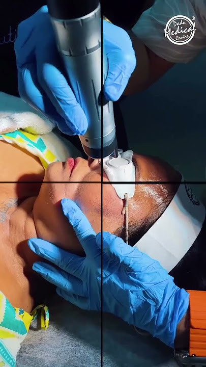 Q Switch Laser treatment