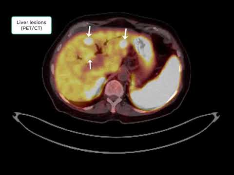 Neuroendocrine Tumor (Gallium-68 DOTATATE PET/CT) - YouTube