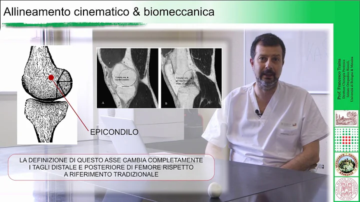 Medial Pivot & Allineamento Cinematico - F. Traina