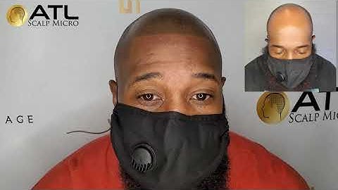 REAL CLIENT TESTIMONIAL! Atlanta Scalp Micropigmentation at ATL Scalp Micro - Hair Loss Expert