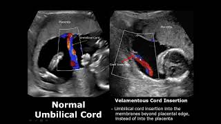 Umbilical Cord Ultrasound Normal Vs Abnormal Image Appearances Comparison | Fetal USG | Obstetric