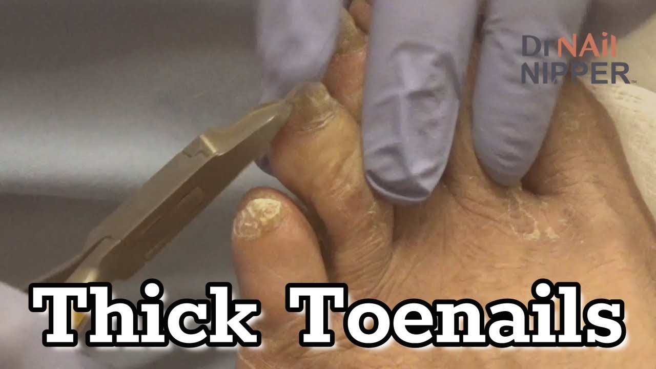 More Thick Toenails.  Dr Nail Nipper Support. FEET-ure Friday (2022)