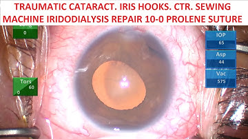 Traumatic cataract. Iris Hooks. CTR. Sewing Machine Iridodialysis Repair 10-0 Prolene Suture.