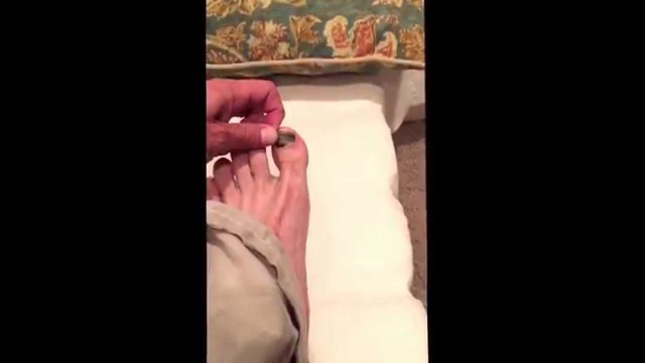 Losing a toenail after running the Leadville Trail ultra marathon