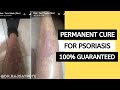 How to get rid of psoriasis naturally  permanently with one diet in hindi  dr raj satpute  jyovis