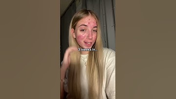 POV: Red light therapy gave you the WORST glow up 😖 #skincarefyp #beautyskin #healthyskin #acne