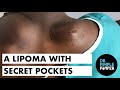 A Lipoma with Secret Pockets