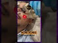Acne Treatment | Clear, Smooth & Confident Skin | Asthederm by Jasmine