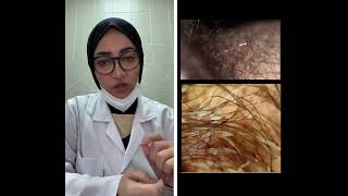 #Trichomycosis axillaris داء الفِطريّات الشّعريّة الإبطيّ