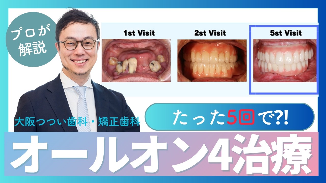 【プロが解説】たった5回の来院で劇的変化？！オールオン４治療を解説