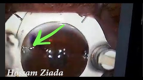 Summary: Incomplete cut flap with unusual management !!! #Hossam Ziada