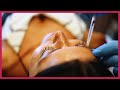 How Can I Get Rid Of Botox Age Related Wrinkles How Can I Get Rid Of Botox Age Related Wrinkles