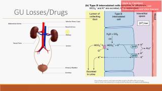 Non-Anion Gap Metabolic Acidosis - Updated Version