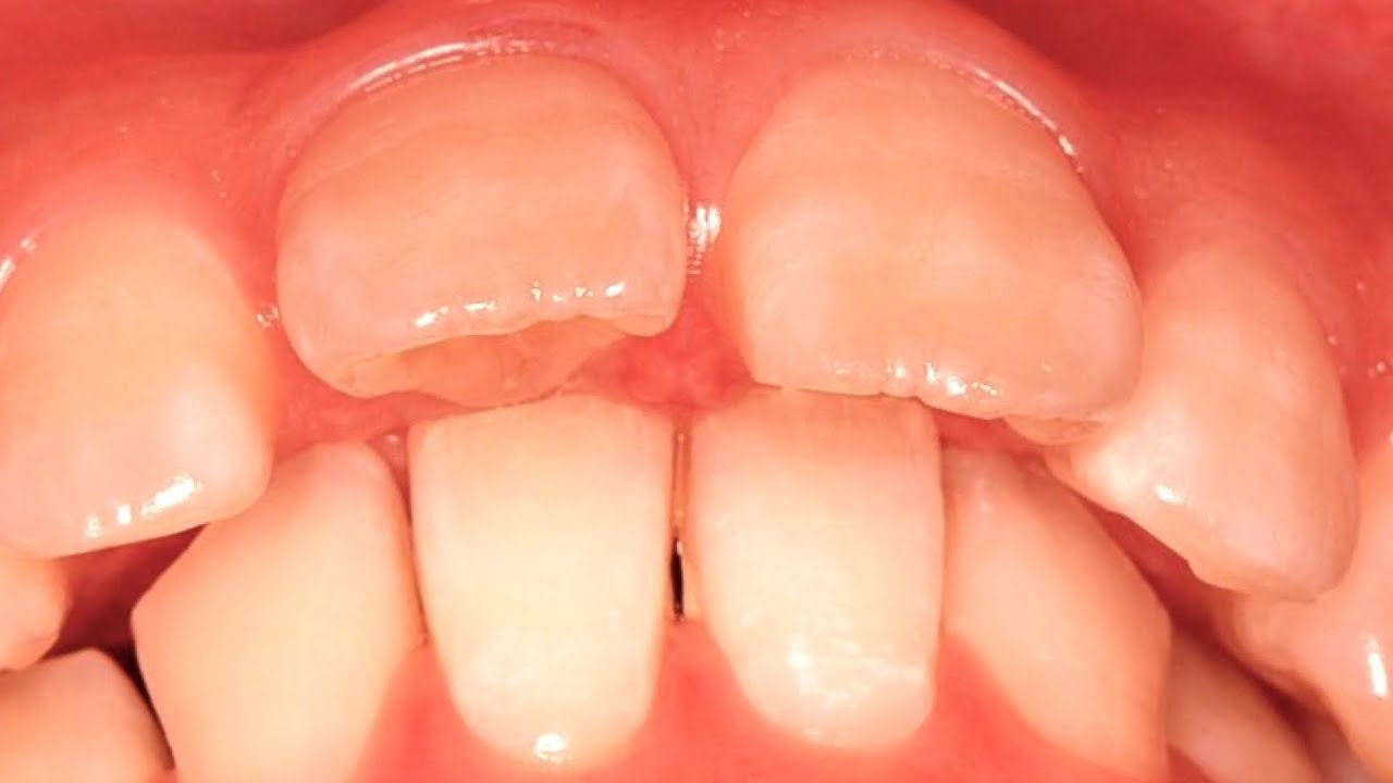 下の前歯が上の歯茎を噛むほど咬み合わせが深い上顎前突の矯正治療　Cases where the lower front teeth bite into the upper gums