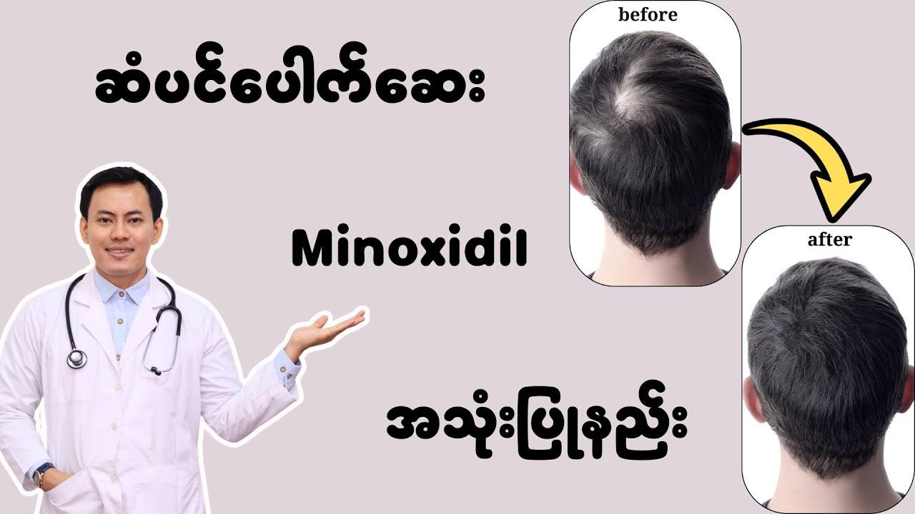 ဆံပင်ပေါက်ဆေး Minoxidil အသုံးပြုနည်းနှင့် ဒီဆေးက အခြားအမွှေးတွေရော ပေါက်စေသလား ?