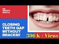 How to close gaps between teeth WITHOUT BRACES FAST? Dr. Srishti Bhatia #GapAlign
