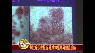 20111005帶狀疱疹醫療支出高 平均每次5萬住院費
