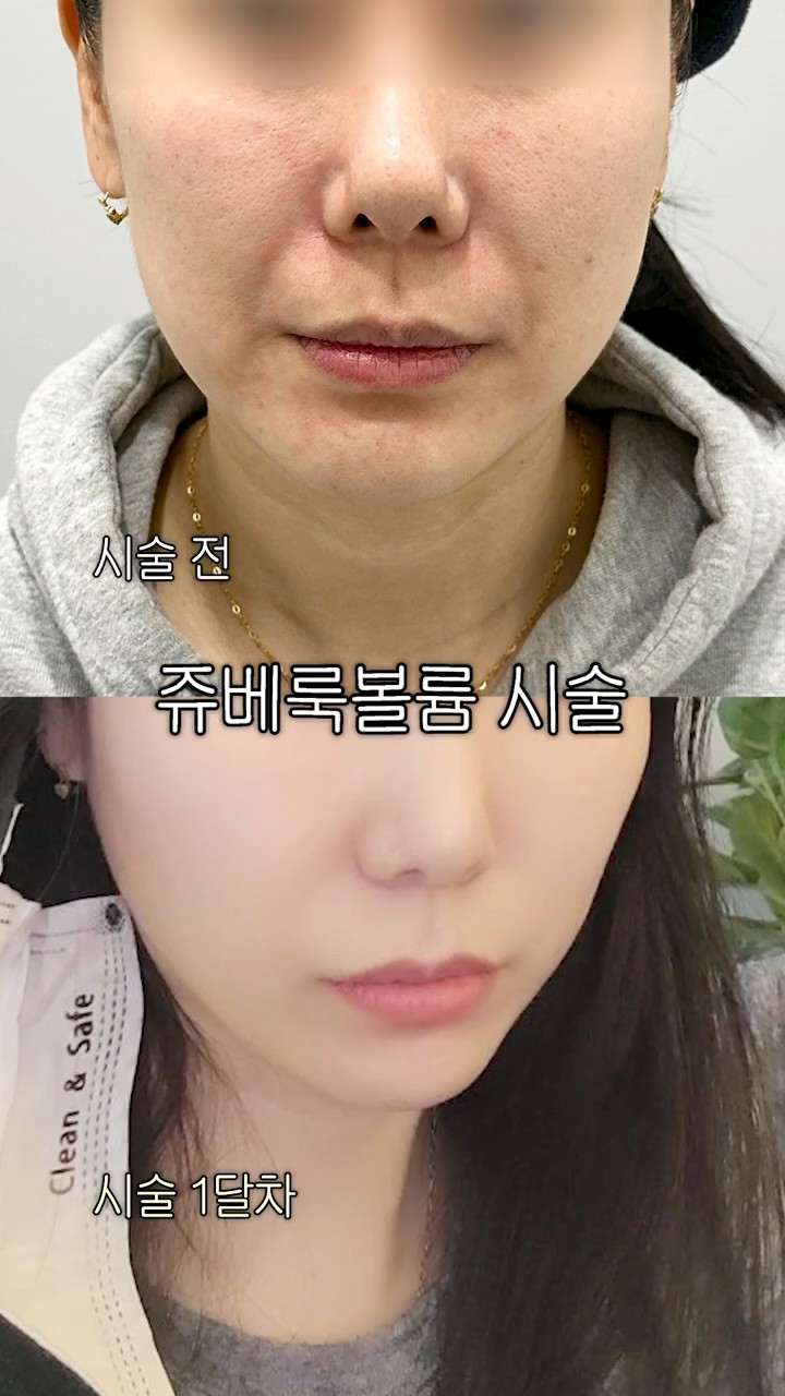 쥬베룩볼륨은 자연스럽게 사라질까?