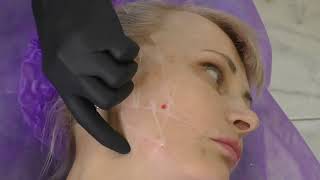 видео: Ретроградный лифтинг Фрагмент картинка: Ретроградный лифтинг Фрагмент