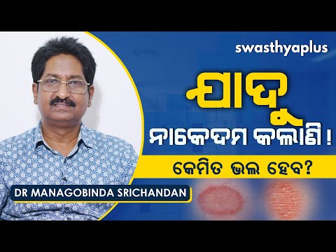 ଯାଦୁ କେମିତି ଭଲ ହେବ? | Dr Managobinda Srichandan on Fungal infection in Odia | Ringworm